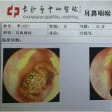 Spider Lived in Woman's Ear Canal for 5 Days